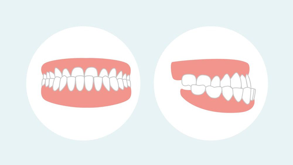 Understand Underbite: Causes & Treatment Options