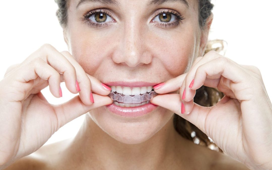 How Does Invisalign Work?