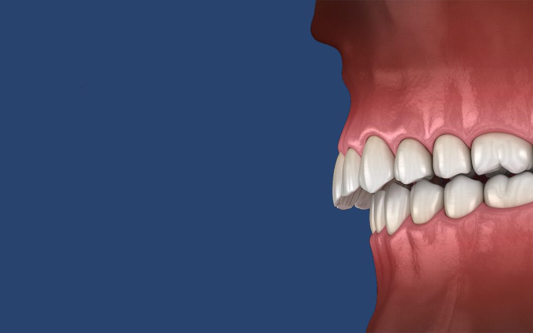 Overbite Basics: Understanding Causes, Symptoms, and Treatment